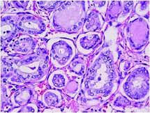 Disorders Of The Thyroid Gland And Parathyroid Glands Chapter 18 Pediatric Head And Neck Pathology