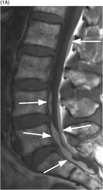 subdural space spinal cord