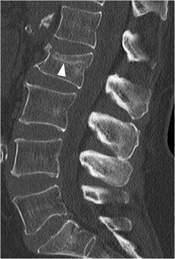 Acute and chronic vertebral compression fractures, Radiology Case