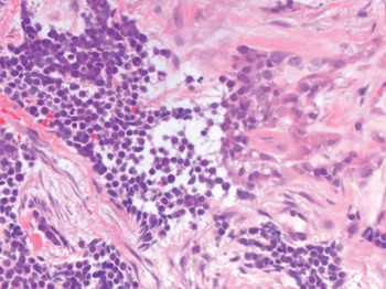 Introduction to small round-cell tumors (Chapter 14)