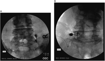 Lumbar Facet Irritation