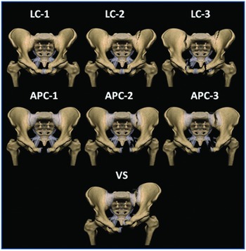 Pelvic Fractures | UW Emergency Radiology