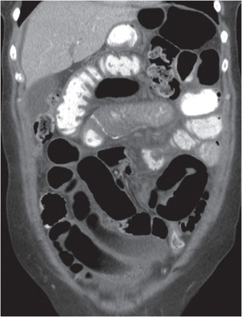 Incarcerated femoral hernia with small bowel obstruction, Radiology Case