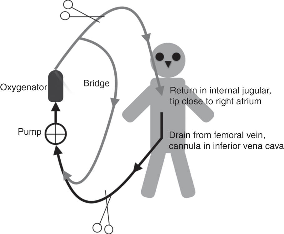 The ECMO circuit (Chapter 3) - ECMO in the Adult Patient
