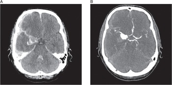 Subarachnoid Hemorrhage (SAH) - Brain, Spinal Cord, and Nerve Disorders -  Merck Manuals Consumer Version