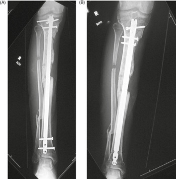 Suprapatellar nailing effective for tibial shaft, periarticular fractures