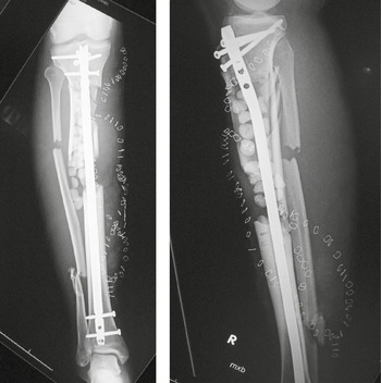 Children | Free Full-Text | Elastic Stable Intramedullary Nailing for  Treatment of Pediatric Tibial Fractures: A 20-Year Single Center Experience  of 132 Cases