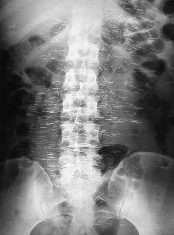 Foreign Bodies Chapter 10 Radiologic Guide to Orthopedic Devices