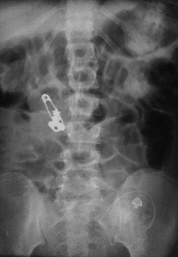 Toy beads puncture girl's intestine: Chinese surgeons remove 61 magnetic  beads from tummy of child, 4, after she swallowed the lot