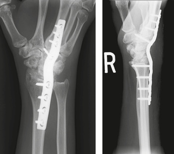 2/3 Ring Fixator For Tibial & Femur Fracture - Orthopedic Drills