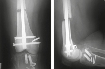 Fracture Fixation (Chapter 3) - Radiologic Guide to Orthopedic Devices