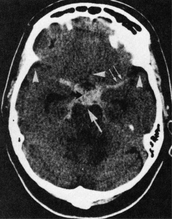 interpeduncular cistern hemorrhage