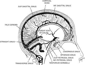 Venous And Dural Sinus Thrombosis Chapter 13 Vertebrobasilar Ischemia And Hemorrhage