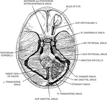 Venous And Dural Sinus Thrombosis Chapter 13 Vertebrobasilar Ischemia And Hemorrhage