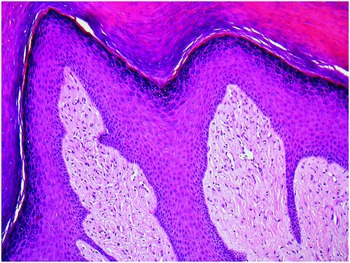 High-power view of fibrous area with ropey collagen bundles and