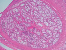 gleason 3+ 3 = 6 adenocarcinoma de próstata