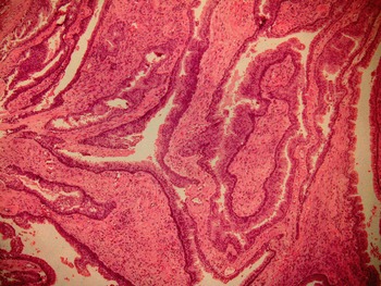 Tumors and Tumor-like Conditions of the Prostate Stroma (Chapter