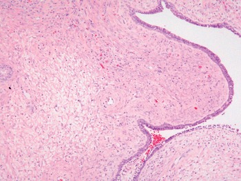 Tumors and Tumor-like Conditions of the Prostate Stroma (Chapter