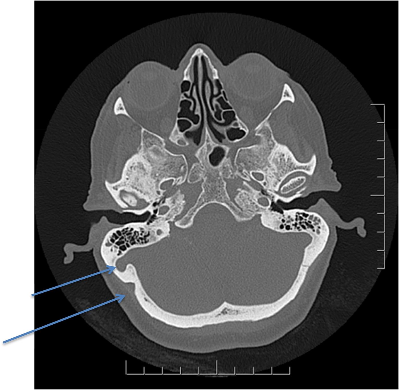 Clipping Of Sigmoid Sinus Diverticulum How I Do It The Journal Of   Urn Cambridge.org Id Binary Alt 20181004021537 40807 OptimisedImage S0022215118001287 Fig5g 