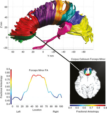 Diffusion Tensor Imaging in Traumatic Brain Injury, Neuropsychology