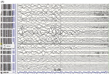 Deep anomaly detection of seizures with paired stereoelectroencephalography  and video recordings