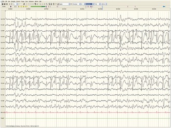 Neonatal And Pediatric Electroencephalogram Chapter 14 Understanding Epilepsy