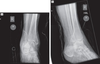 Ankle Fracture - Trimalleolar Fracture of the Right Ankle – Stock Trial  Exhibits