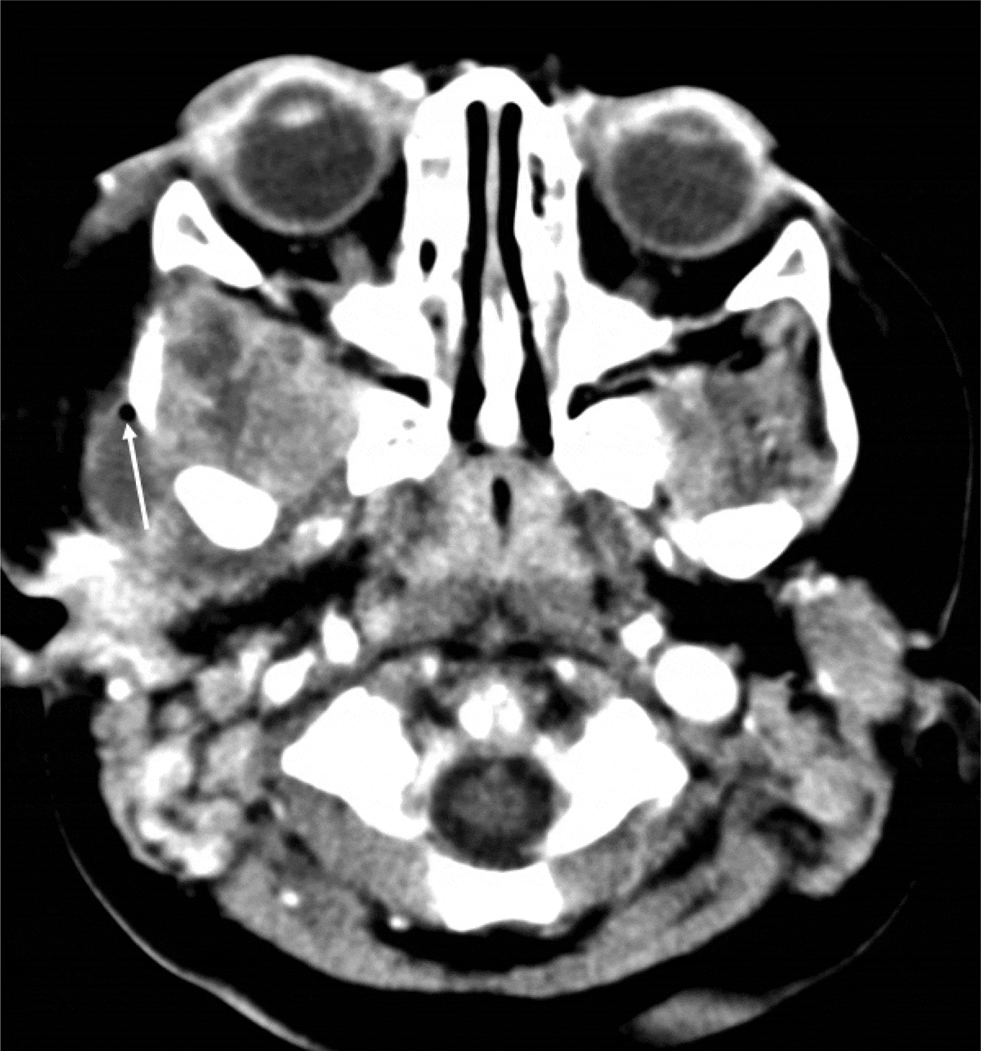 Radiology Of Acute Mastoiditis And Its Complications A Pictorial Review And Interpretation 8949