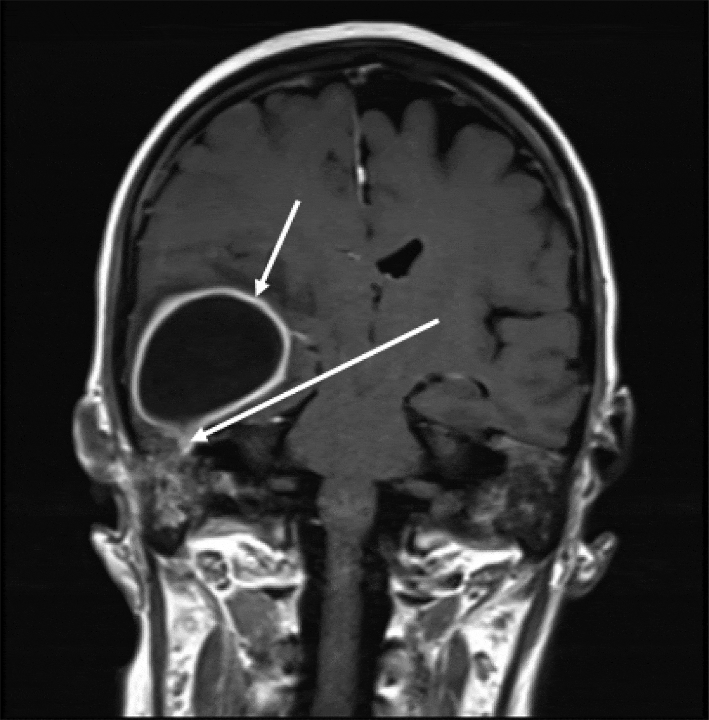 Radiology Of Acute Mastoiditis And Its Complications A Pictorial Review And Interpretation 9596