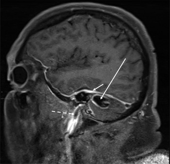 Radiology of acute mastoiditis and its complications: a pictorial ...