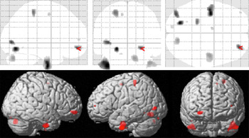 Cureus, Structural MRI Brain Alterations in Borderline Personality Disorder  and Bipolar Disorder