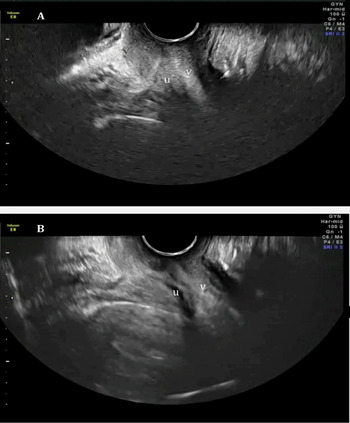 Baseline Sonographic Assessment Of The Female Pelvis Chapter 2 Gynaecological Ultrasound Scanning