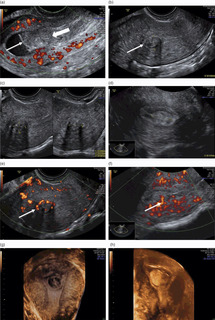 Baseline Sonographic Assessment Of The Female Pelvis Chapter 2 Gynaecological Ultrasound Scanning