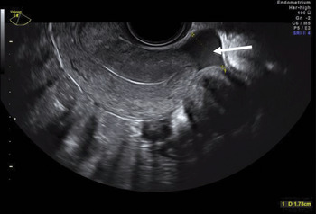 Baseline Sonographic Assessment Of The Female Pelvis Chapter 2 Gynaecological Ultrasound Scanning