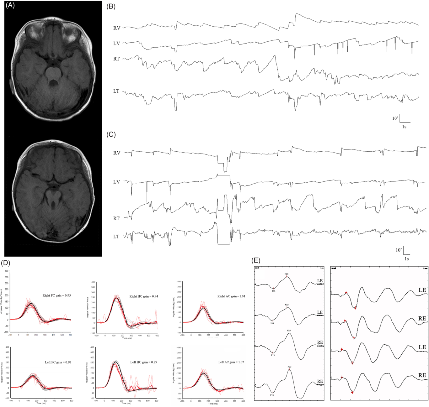 Hemi-seesaw Nystagmus in Joubert Syndrome | Canadian Journal of ...