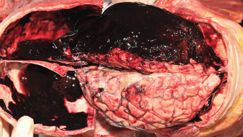 epidural hematoma gross