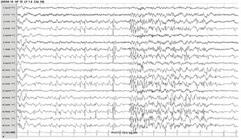 たなか Medication-Resistant Epilepsy Syndromes in Children (Chapter 13