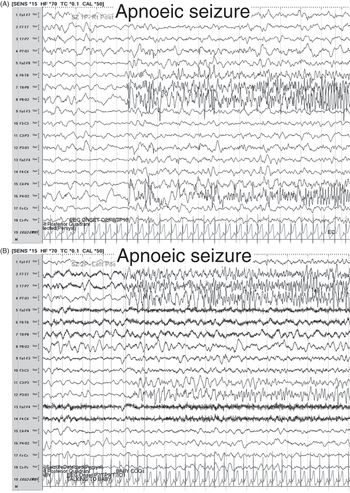 Medication-Resistant Epilepsy Syndromes in Children (Chapter 13