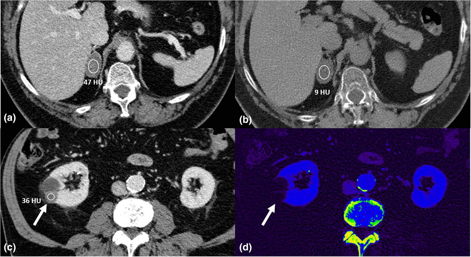 Material decomposition with dual- and multi-energy computed tomography ...