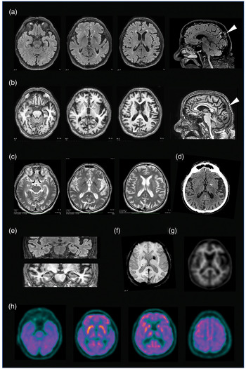 Diogenes Syndrome In Dementia: A Case Report | BJPsych Open | Cambridge ...