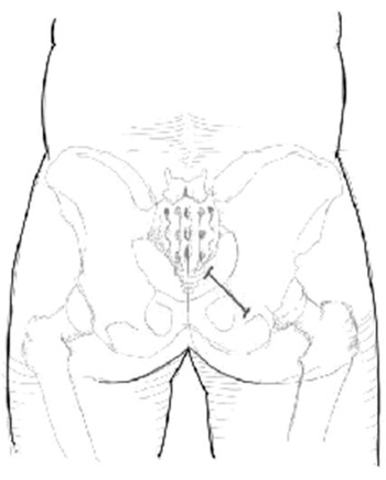 bilateral pudendal nerve block