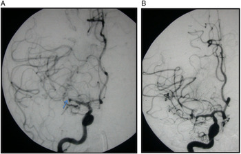 Interventional Neuroradiology A Review Canadian Journal Of Neurological Sciences Cambridge Core Interventional Neuroradiology A Review Canadian Journal Of Neurological Sciences Cambridge Core