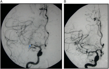 Interventional Neuroradiology A Review Canadian Journal Of Neurological Sciences Cambridge Core