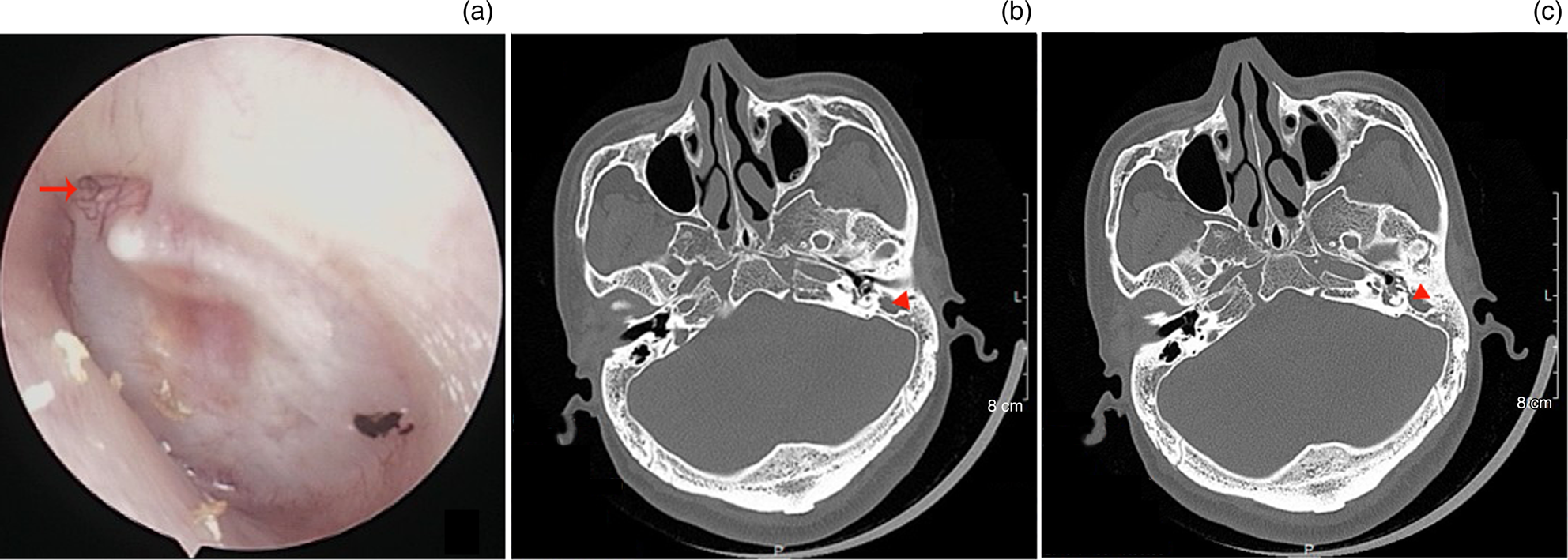 Middleear or mastoid granulation pathology associated with retraction