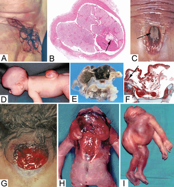 Neural Tube Defects and Patterning Defects Perinatal Neuropathology