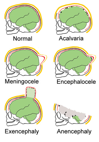 cranial meningocele