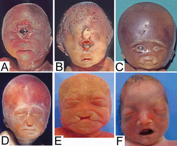 Malformations Section 5 Perinatal Neuropathology