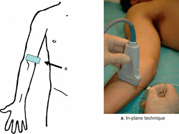 Core Products Pelvic Sacral Block Set, Aids in Body Positioning