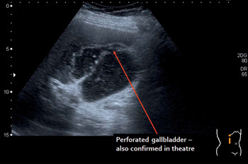 perforated gallbladder ultrasound