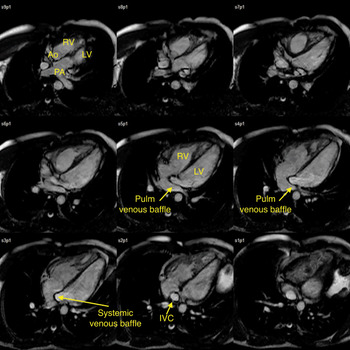 Frontiers  Right and Left Ventricular Strain Patterns After the Atrial  Switch Operation for D-Transposition of the Great Arteries—A Magnetic  Resonance Feature Tracking Study